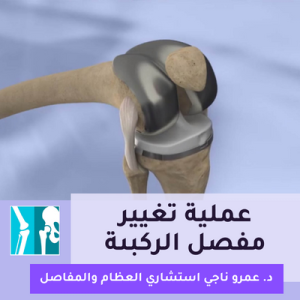 عملية تغيير مفصل الركبة