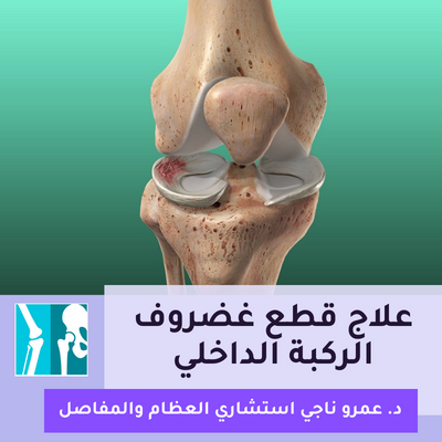 علاج قطع غضروف الركبة الداخلي