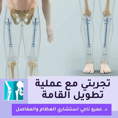 تجربتي مع عملية تطويل القامة