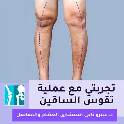 تجربتي مع عملية تقوس الساقين
