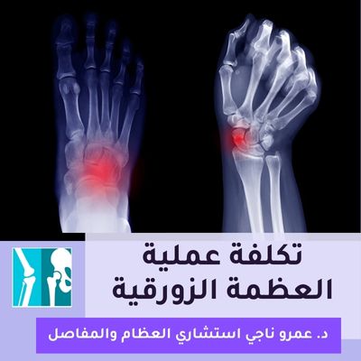 تكلفة عملية العظمة الزورقية