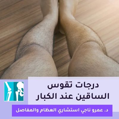 درجات تقوس الساقين عند الكبار