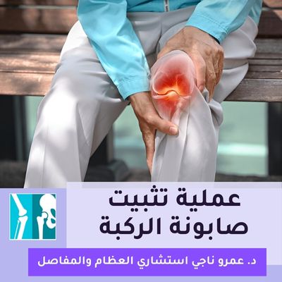 عملية تثبيت صابونة الركبة