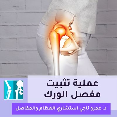 عملية تثبيت مفصل الورك
