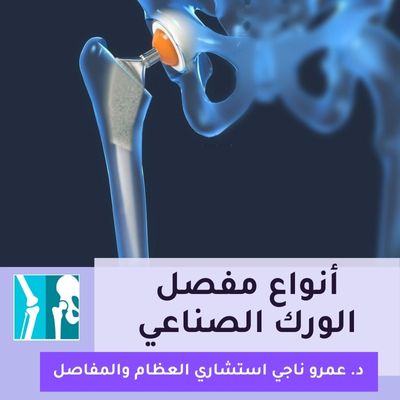 أفضل أنواع مفصل الورك الصناعي