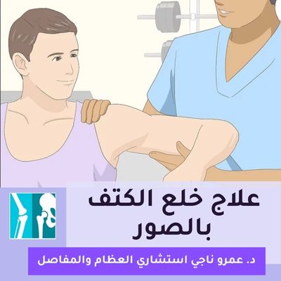 علاج خلع الكتف بالصور