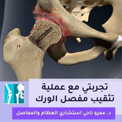 تجربتي مع عملية تثقيب مفصل الورك