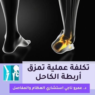 تكلفة عملية تمزق أربطة الكاحل