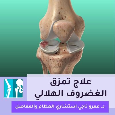 تمزق الغضروف الهلالي