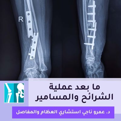 ما بعد عملية الشرائح والمسامير