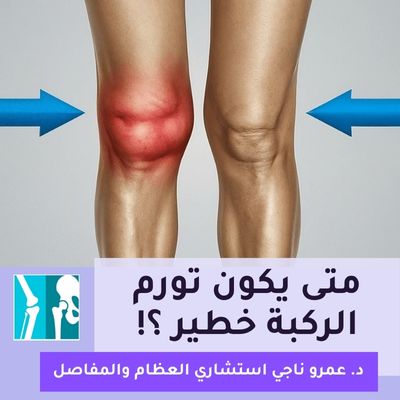 متى يكون تورم الركبة خطير